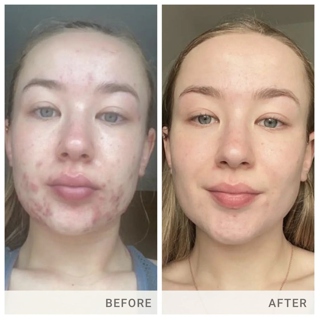 Skin Accumax